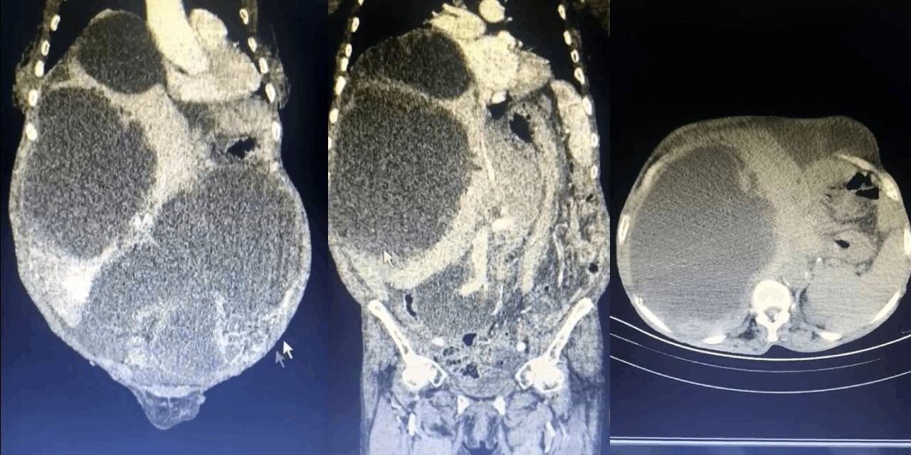Tüm karnı kist kapladı! Doktorlar bile böyle bir şey görmedi