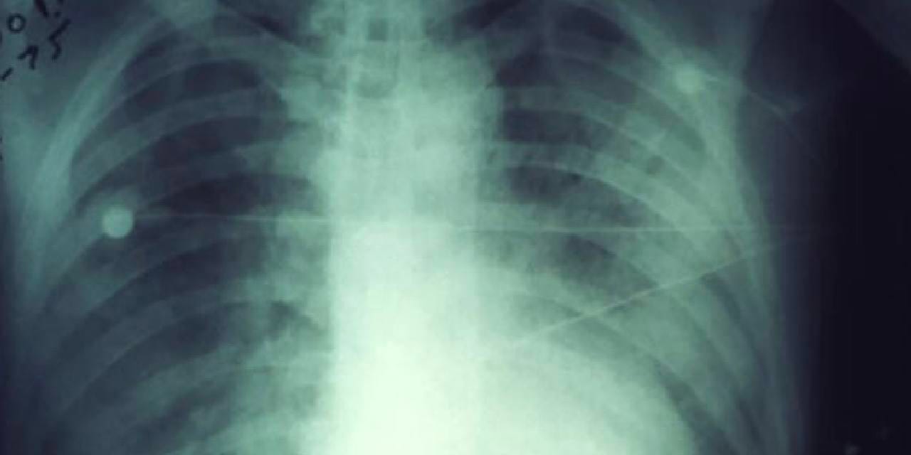 2007’den bu yana bir ilk: Akciğer vebası nedeniyle 1 kişi öldü