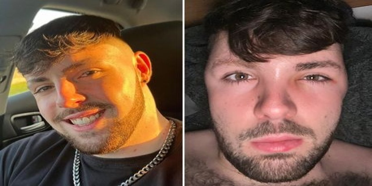 Saç ektirdikten bir gün sonra yüzü balon gibi şişti