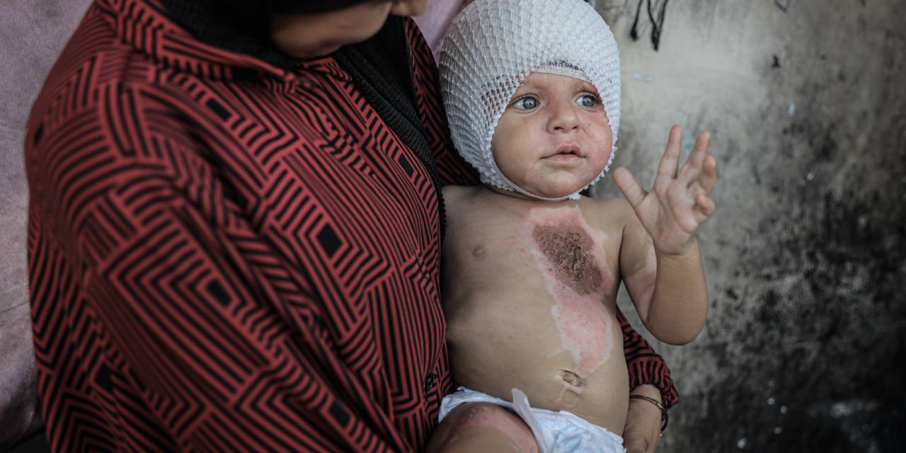 Gazze'de vücudu yanan 1 yaşındaki Muhammed yardım bekliyor