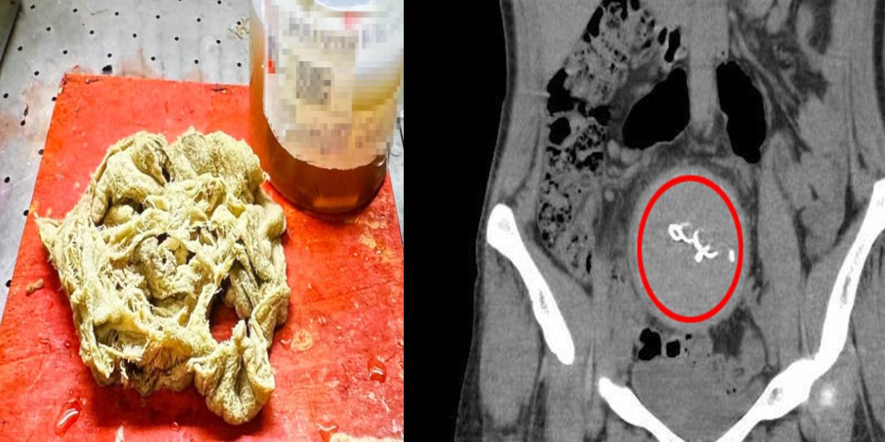 Doğumda karnında gazlı bez unuttular: Soruşturma iki yıl sonra açılabildi