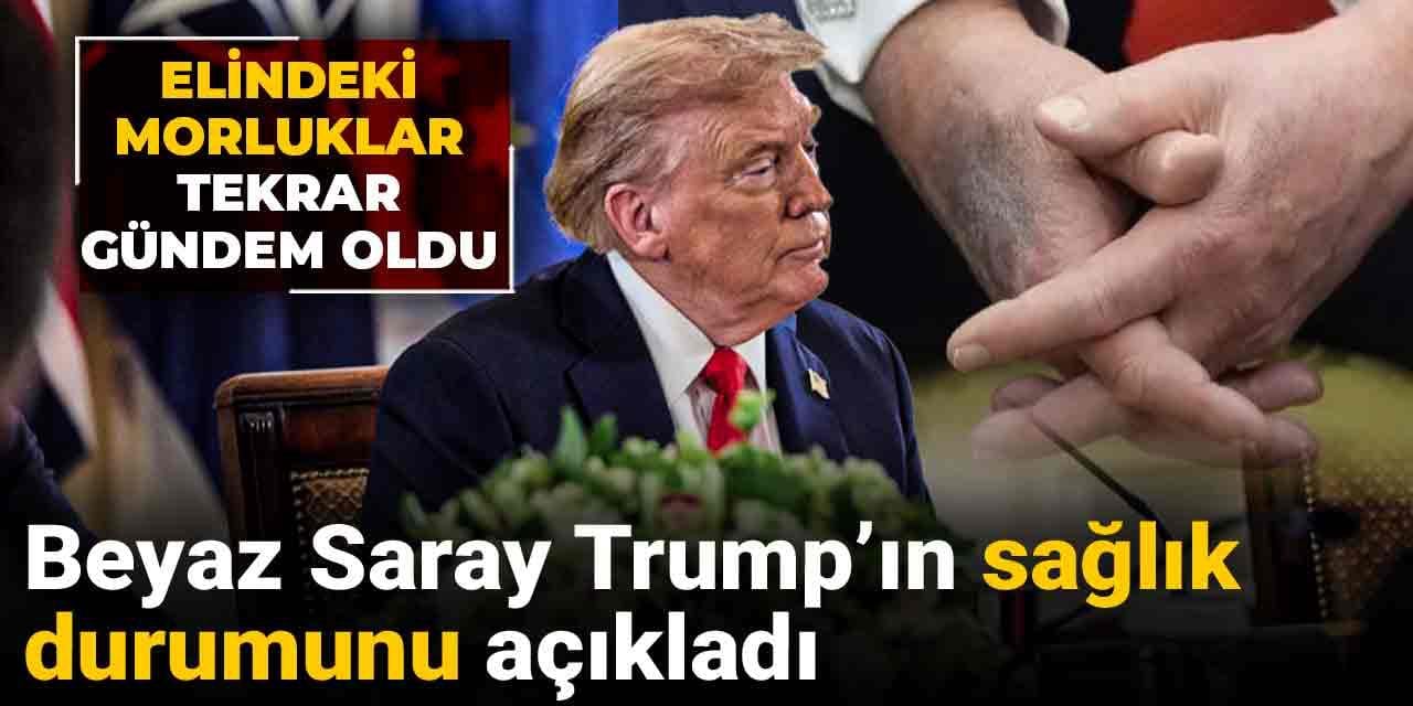 Elindeki morluklar yine görüldü: Trump’ın sağlık durumunu açıklandı