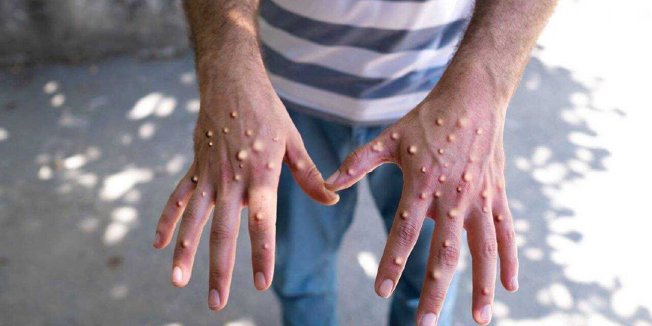 M çiçeği virüsü yayılmaya devam ediyor: Vaka sayısı 467'ye yükseldi