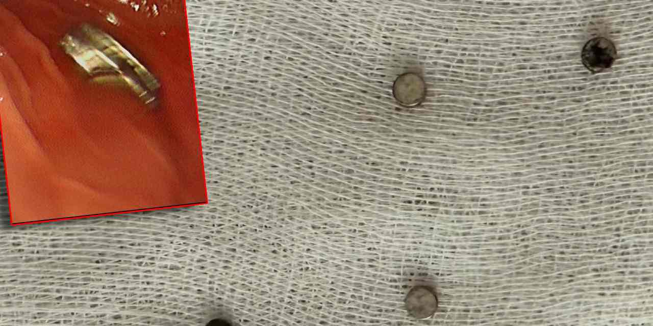 3 yaşındaki çocuğun boğazından 19 mıknatıs çıktı!