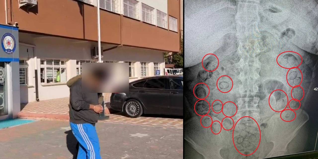 Midesinden 433 gram metamfetamin çıktı