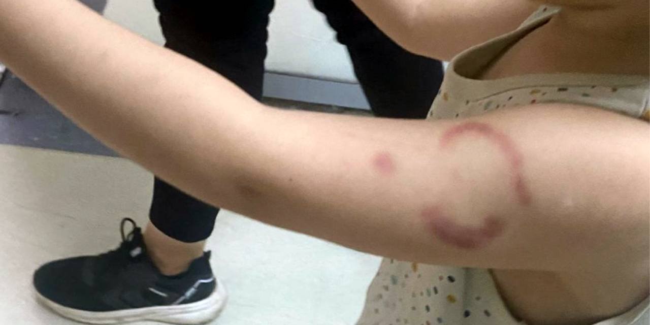 Öğretmen 3 yaşındaki öğrenciyi ısırdı