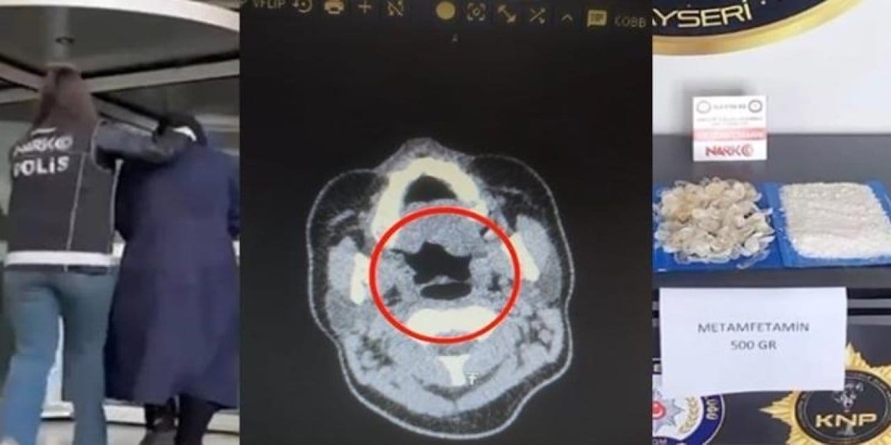 Doktorlar bile inanamadı: Midesinden tam 500 gram metamfetamin çıktı