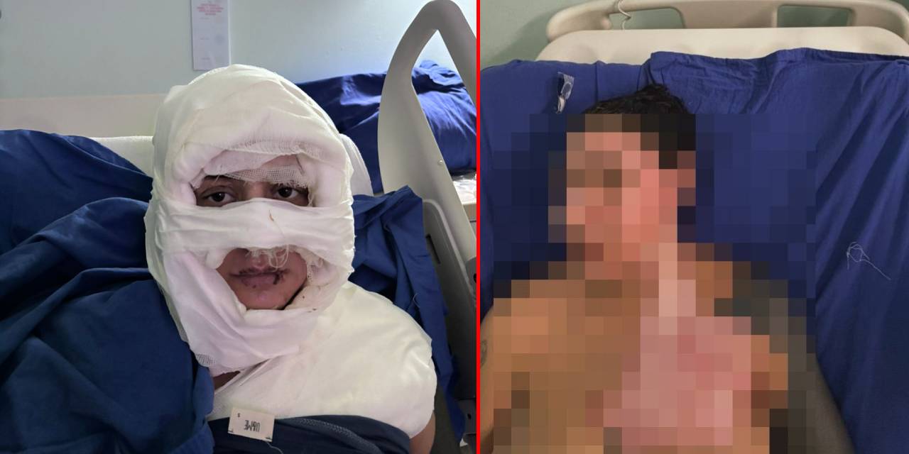 'Kıskançlık' bahanesiyle sevgilisinin çocukluk arkadaşını yaktı! Saldırgan tutuklandı: Şimdi de sevgilisi tehdit ediyor