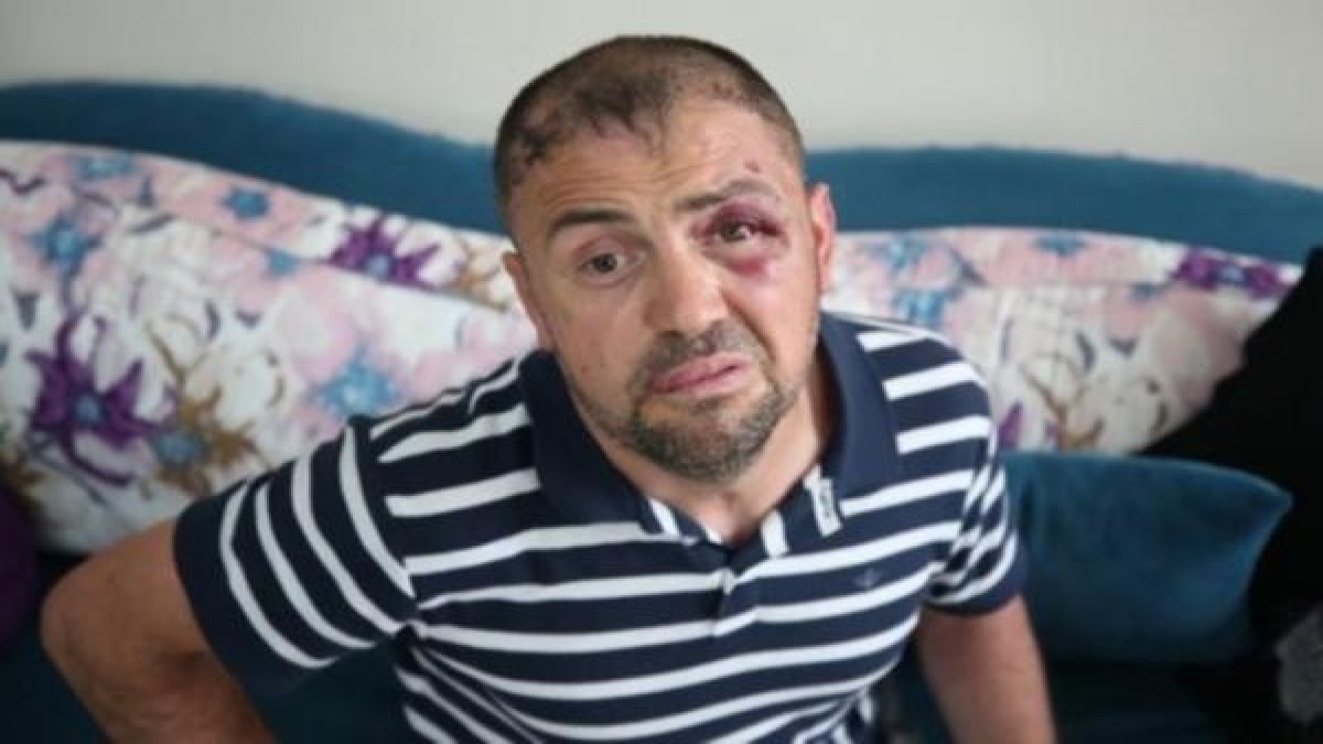 "Sağlam" raporu verilmişti! Gazinin belinde 4 kırık çıktı...