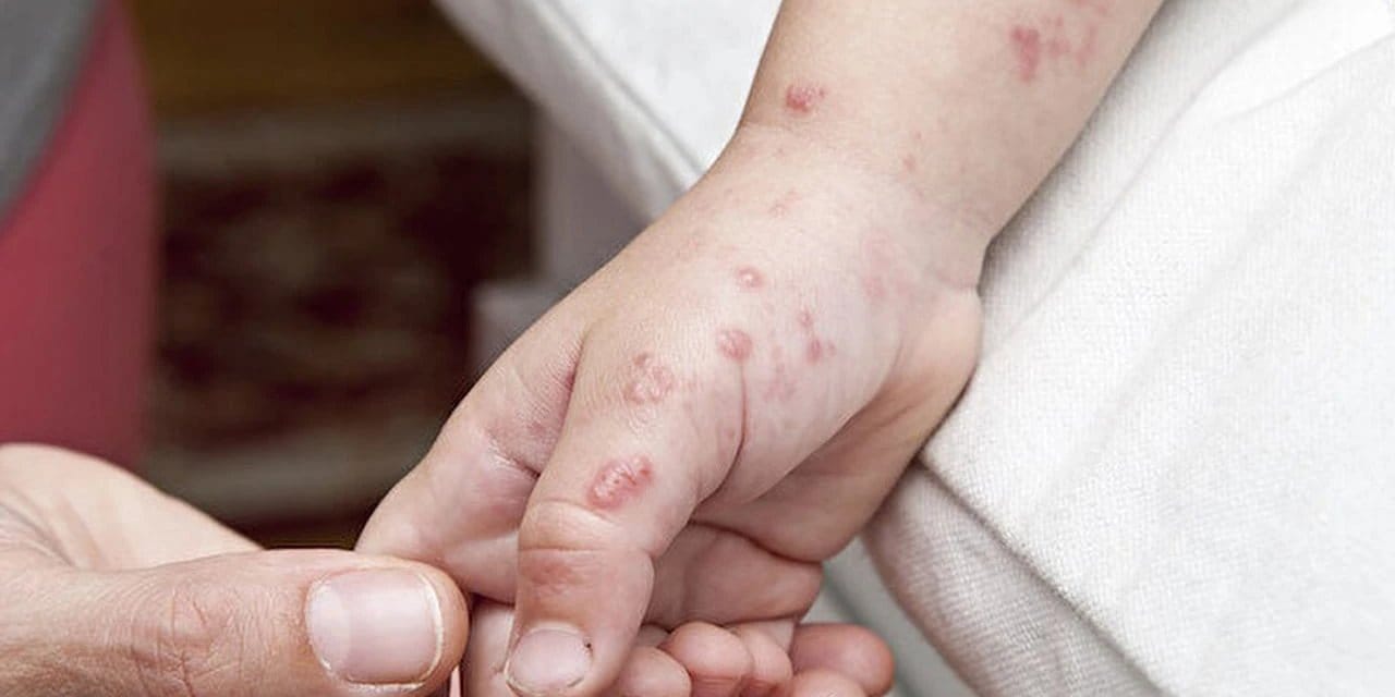 İngiltere alarma geçti: Maymun Çiçeği'nin yeni varyantı ortaya çıktı