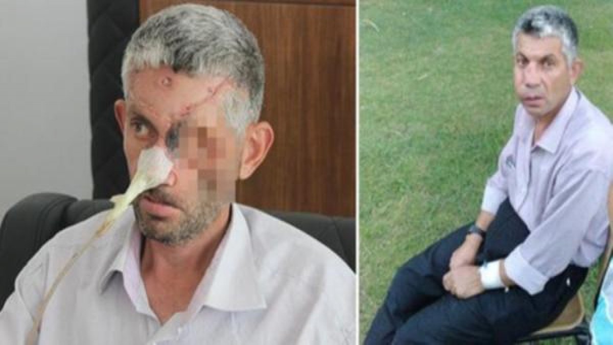 Dişini çektirdi, gözünü kaybetti!