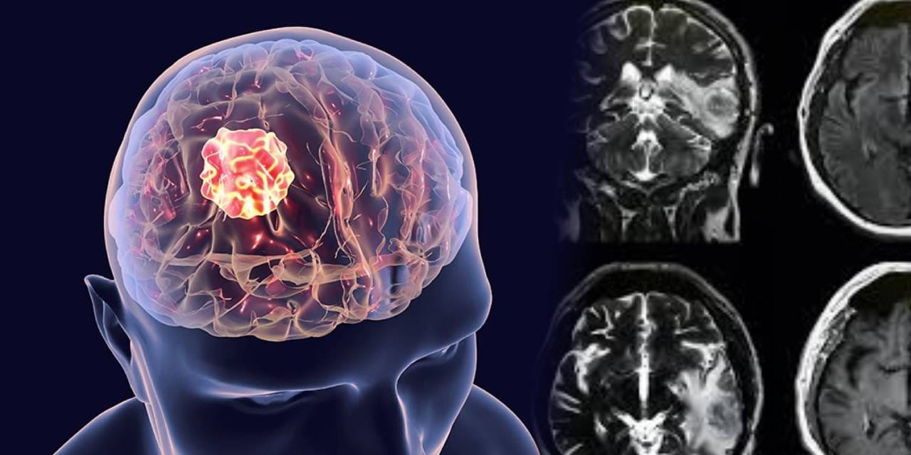 Kaç çeşit beyin tümörü var? Profesör açıkladı