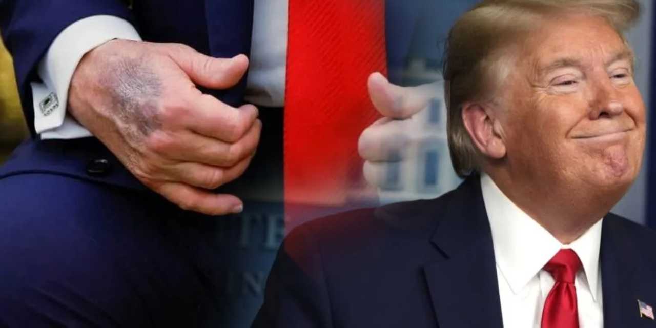 Trump elindeki morlukların nedenini açıkladı: Aşırı dozdan damarlarını patlatmış