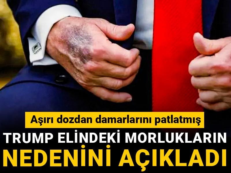 Trump elindeki morlukların nedenini açıkladı: Aşırı dozdan damarlarını patlatmış