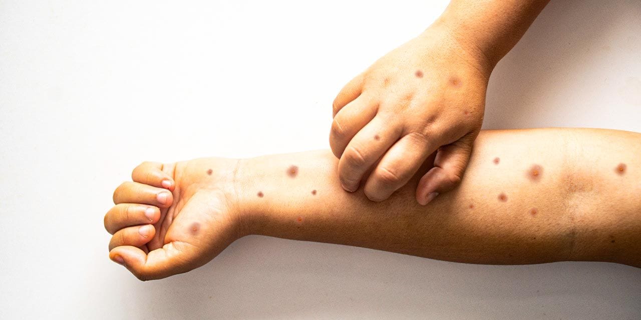 Okullarda suçiçeği salgını başladı!  Bu üç  belirti çocuğunuzda varsa dikkat