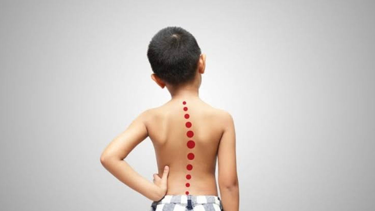 Çocuklarda omuz asimetrisine dikkat: Skolyoz olabilir
