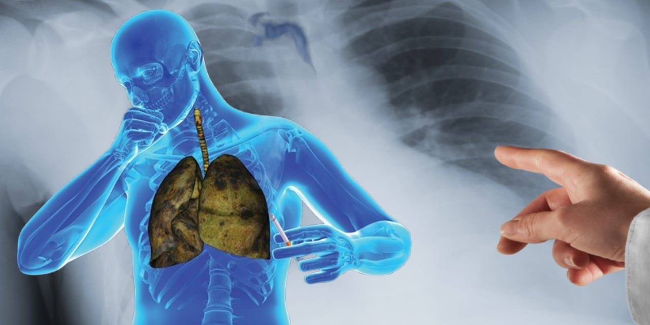 Her yıl 2 milyona yakın insan bu hastalıktan ölüyor!