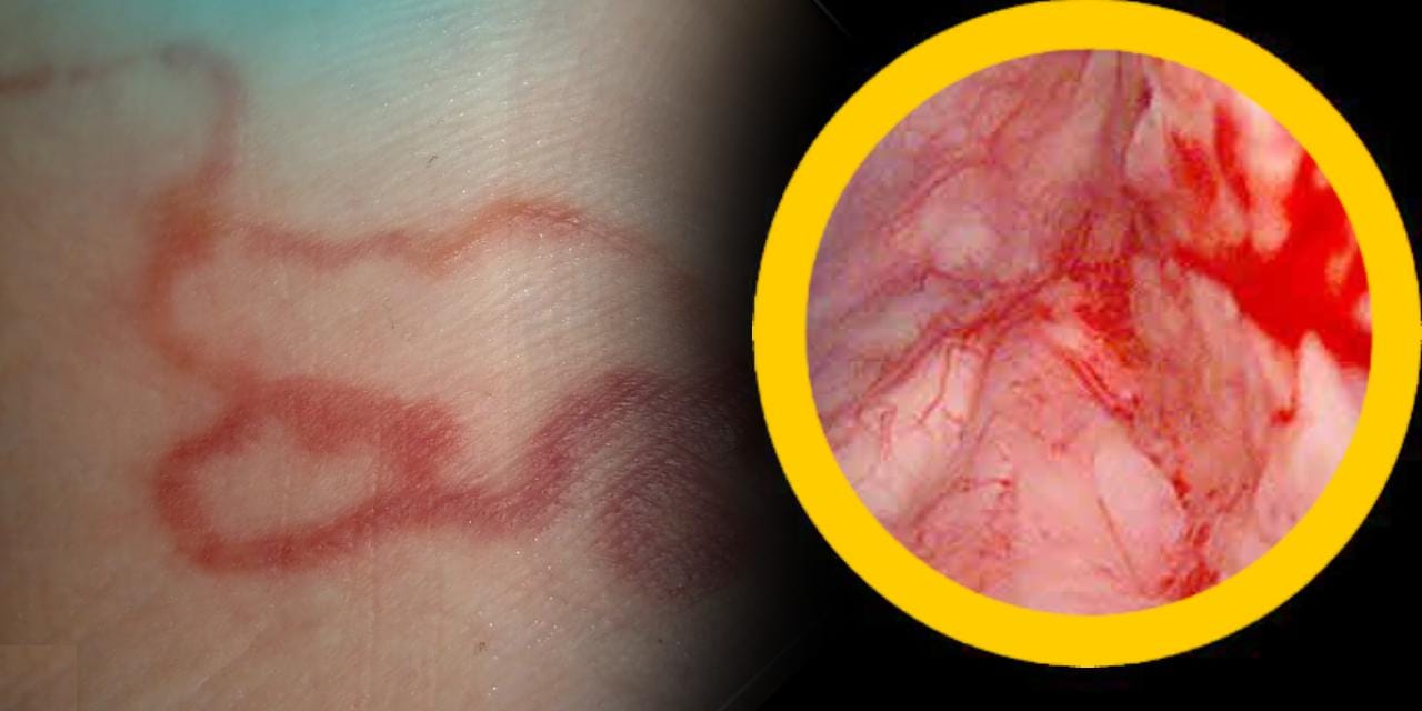 DSÖ cinsel organlara tutunan parazite karşı uyardı! Sudan bulaşıyor