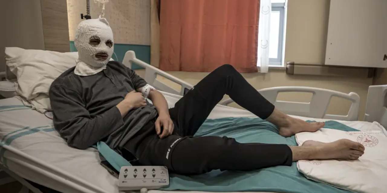 Çakmak gazı tüpü patladı: 19 yaşındaki gencin yüzü ve göğsü yandı