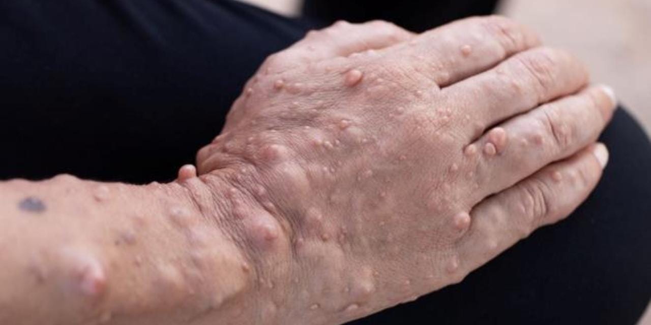 Türkiye'de 5 kat daha fazla görülüyor! Nadir hastalığı engellemenin yolunu açıkladı