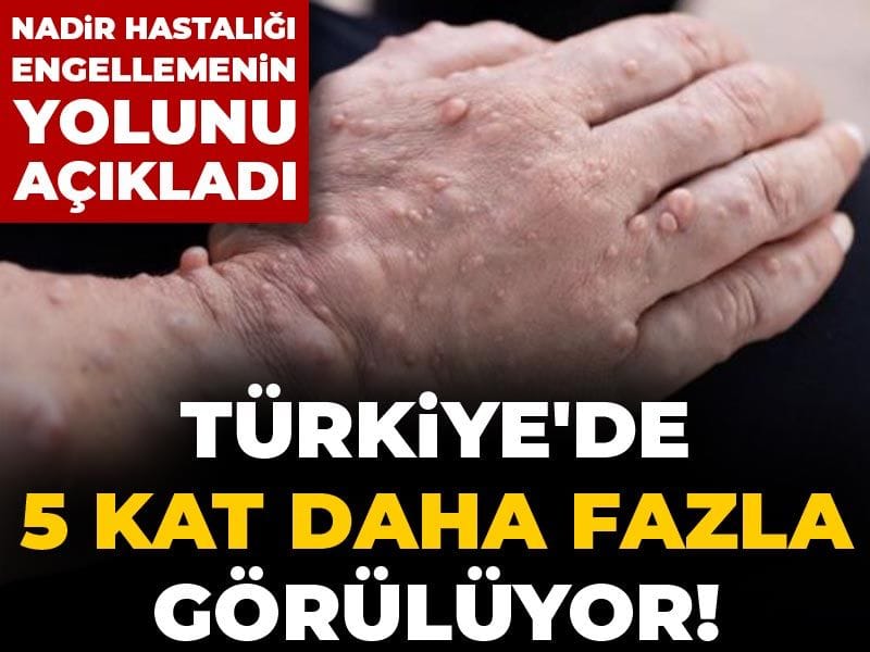 Türkiye'de 5 kat daha fazla görülüyor! Nadir hastalığı engellemenin yolunu açıkladı