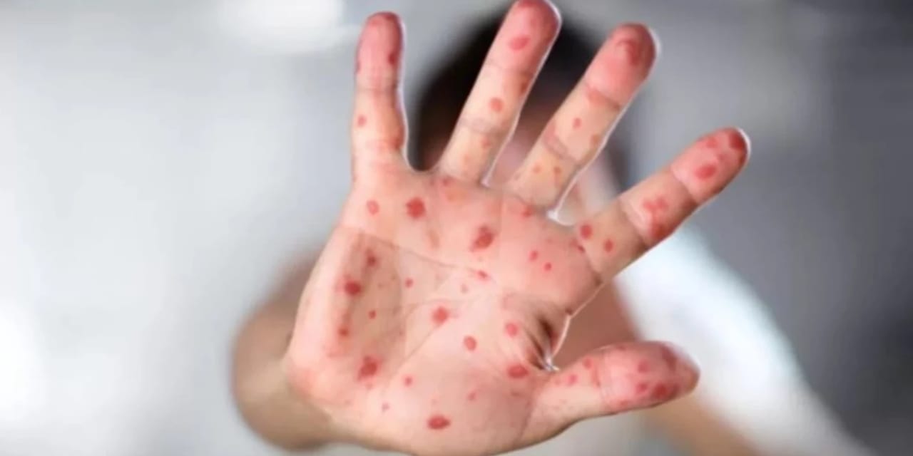 ABD’de kızamık alarmı: Salgın rekor seviyeye yaklaştı