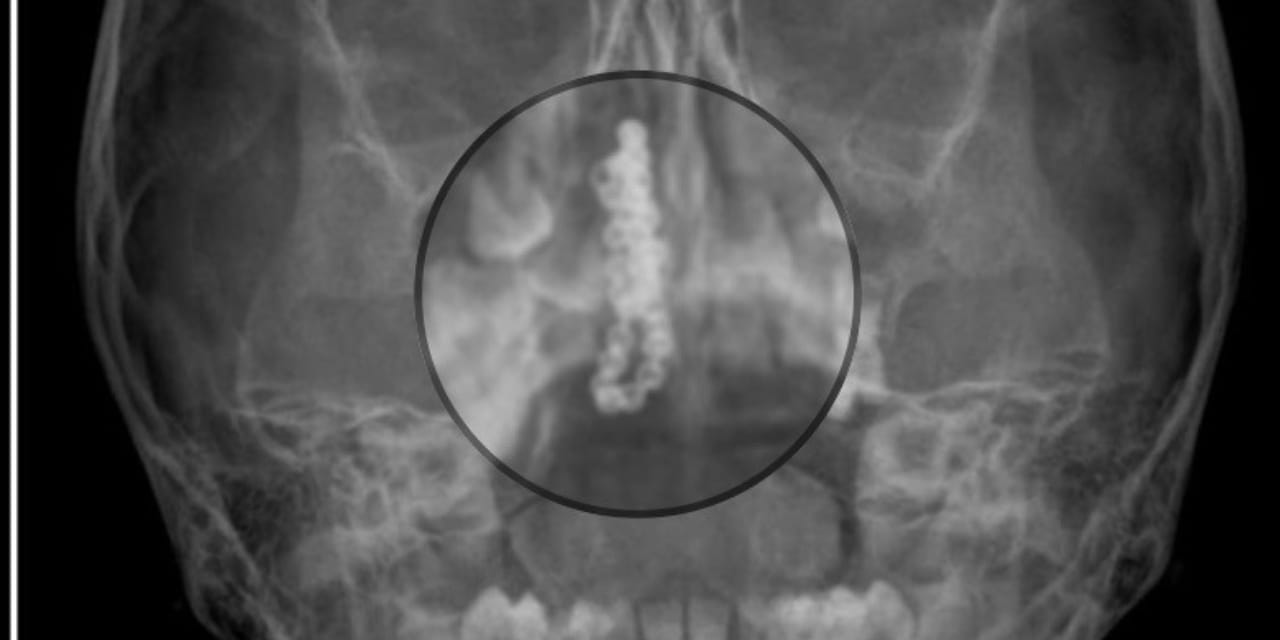 5 yaşındaki çocuğun burnundan çıkan doktorları hayrete düşürdü: Küçücük burna nasıl girmiş?
