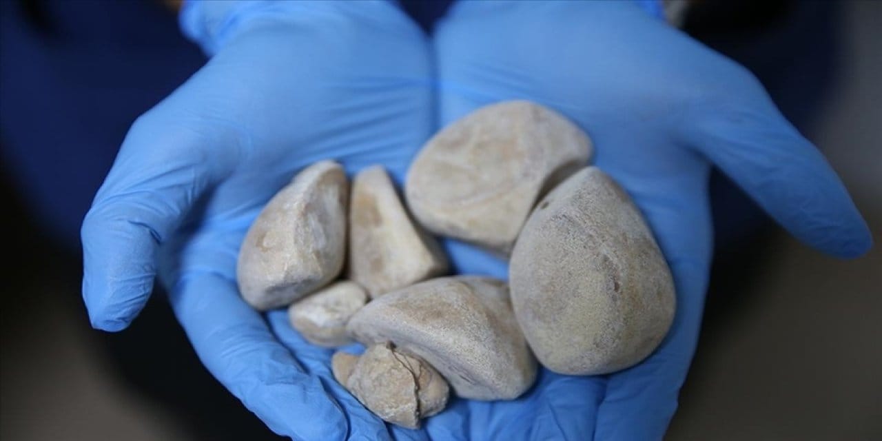 8 yıl boyunca ilaç verip gönderdiler: Engelli yurttaşın vücudundan yarım kilo taş çıktı!