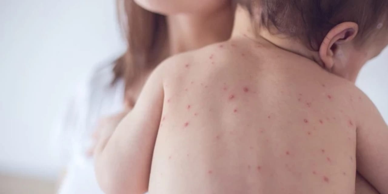 Bangladeş'te kızamık yayılıyor: 7 bin vaka, yüzlerce çocuk hayatını kaybetti