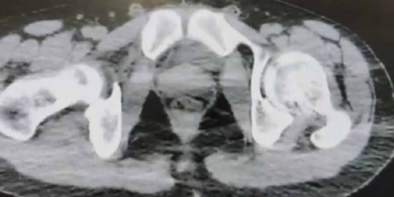 Midelerinde 1 kiloya yakın metamfetaminle yakalandılar