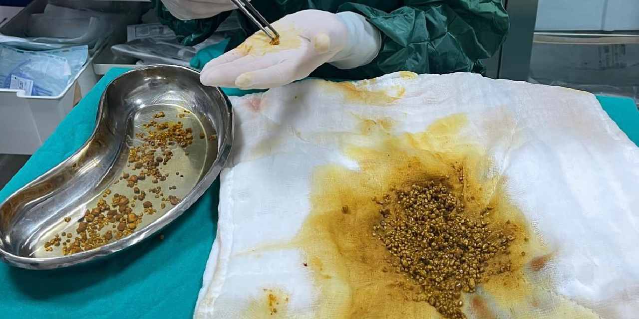 Safra kesesinden 2 bin 67 taş çıkarıldı