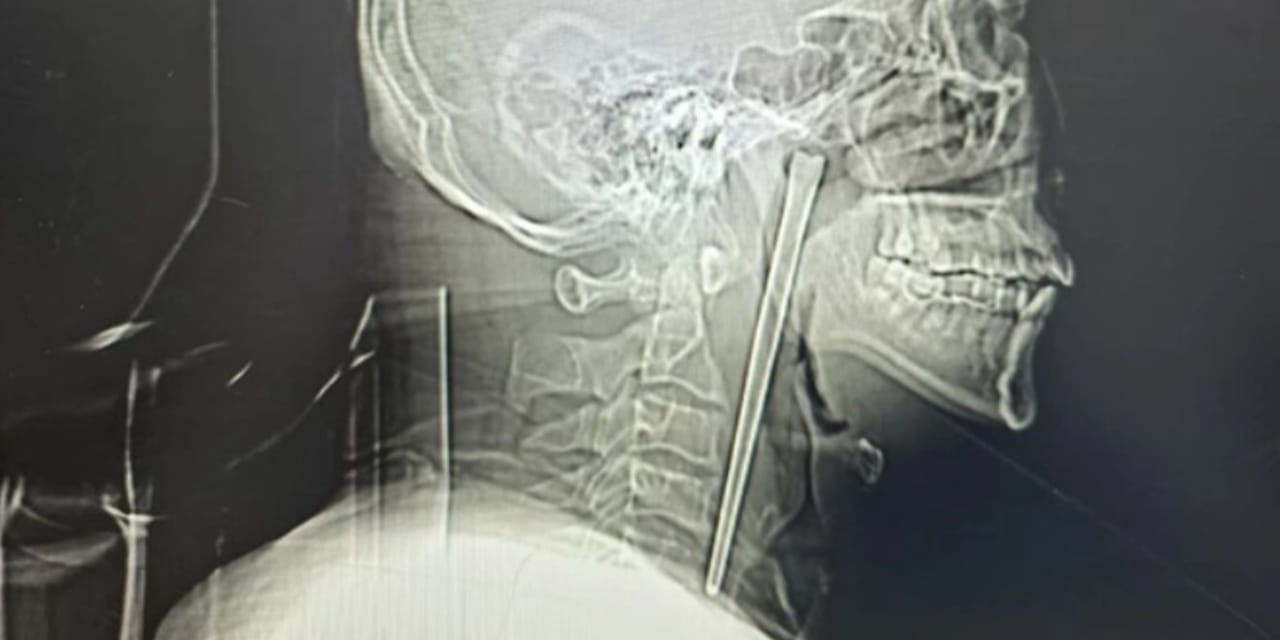 Çoğu insan saniyeler bile dayanamazdı: 12 santimetreyle tam 8 yıl yaşadı