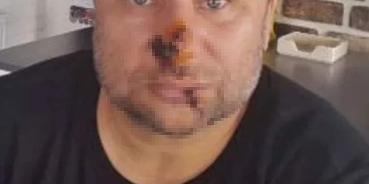 Yoğun bakımdan çıkan ünlü şarkıcı son durumunu açıkladı: Yüzü çürümeye başlamıştı!