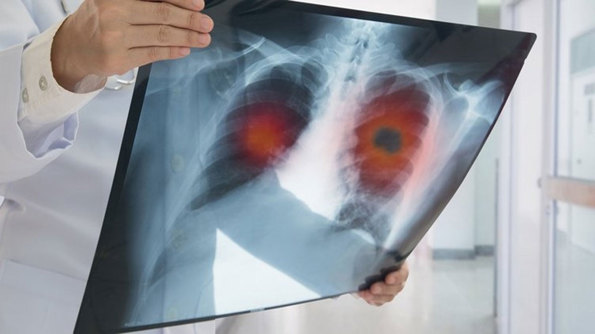 Türkiye'de akciğer kanserinin görülme sıklığı artıyor