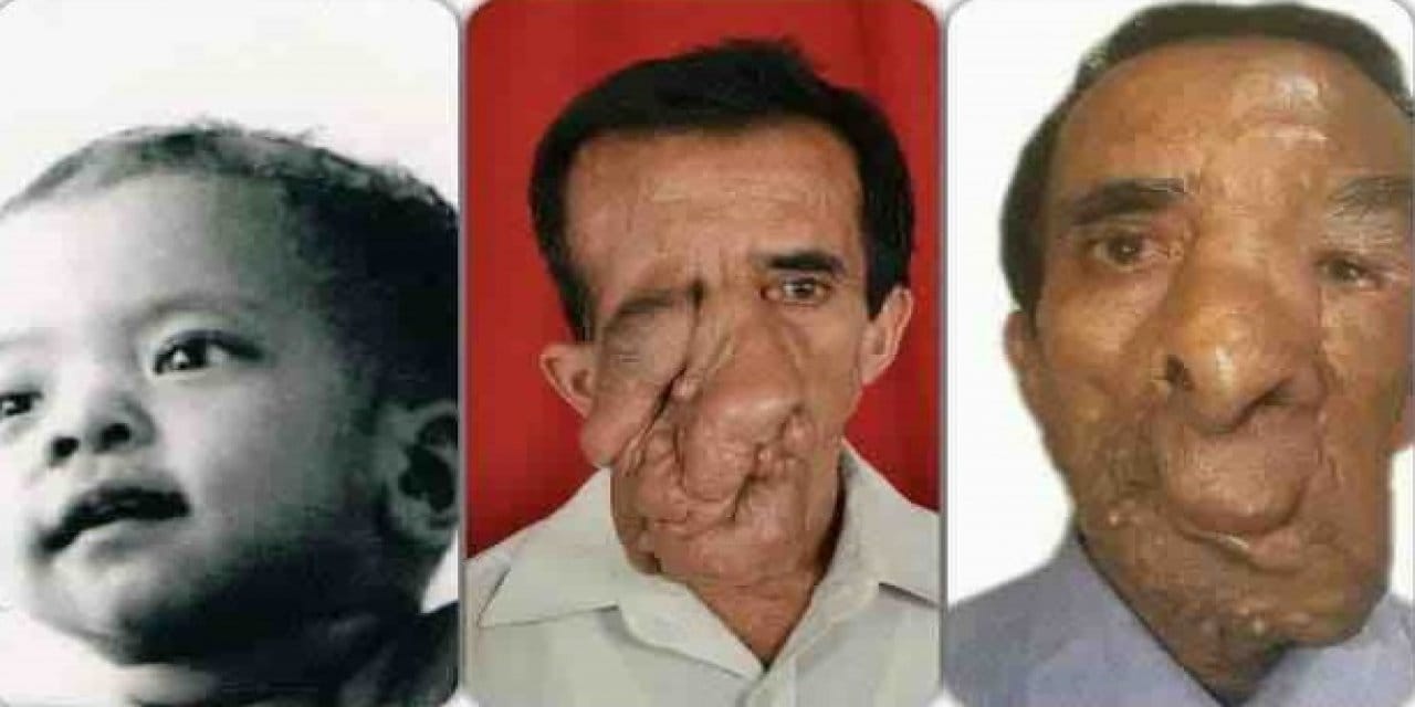 Yüzündeki 25 kilogramlık tümör için 5 ameliyat geçirdi