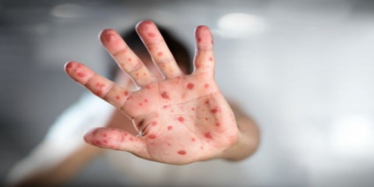 DSÖ: Koronavirüs kısıtlamaları kızamık vakalarını arttırdı