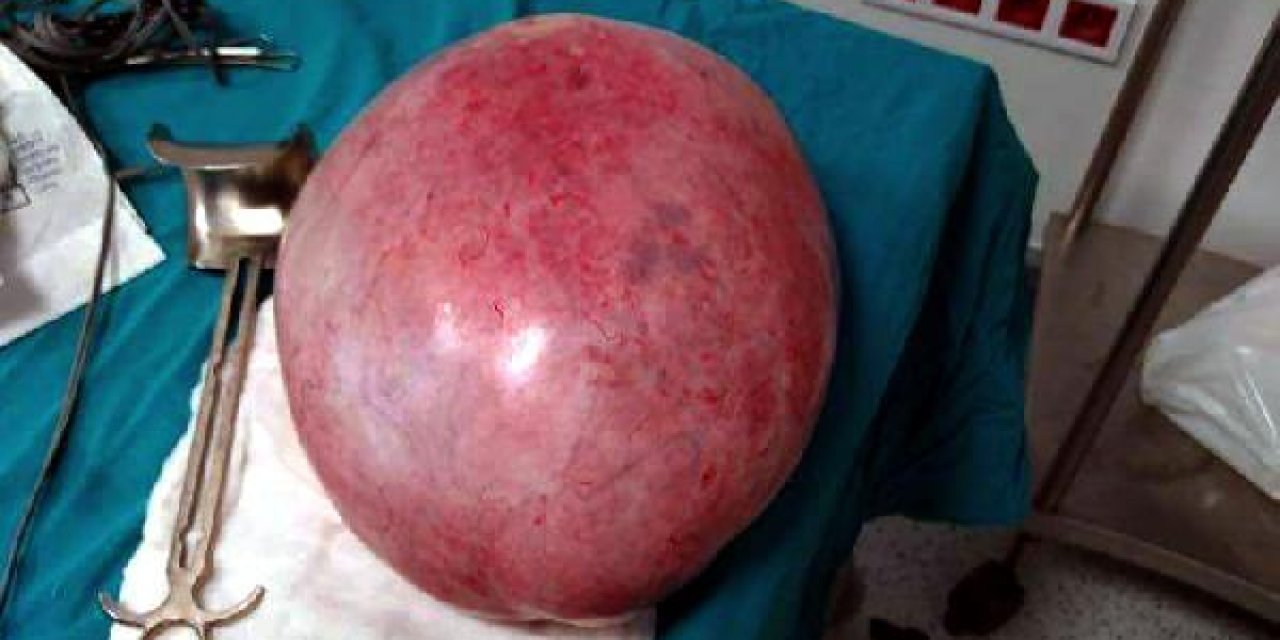 Karnından 9 kilo 800 gram ağırlığında kitle çıktı