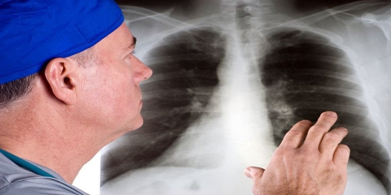 Asbest temasıyla akciğer zarı kanserine neden olan gen bulundu