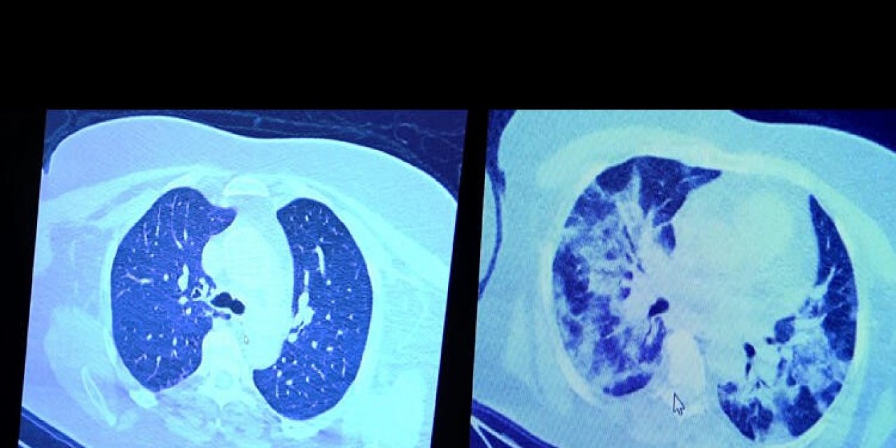 Koronavirüs ilacı kullanan ve kullanmayan hastanın akciğerleri incelendi