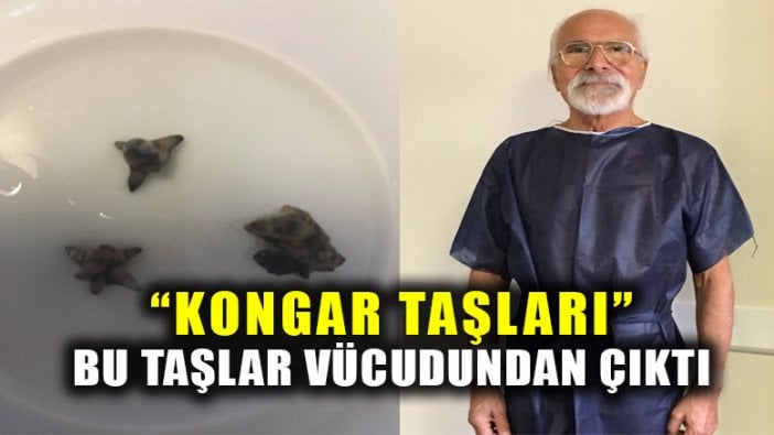 Emre Kongar'ın vücudundan çıkanlar şaşırttı!