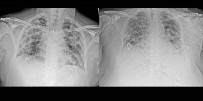 Covid-19'da akciğer tutulumunun yaygınlığı kişiden kişiye değişiyor