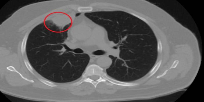 Covid-19, akciğer kanserini taklit etti