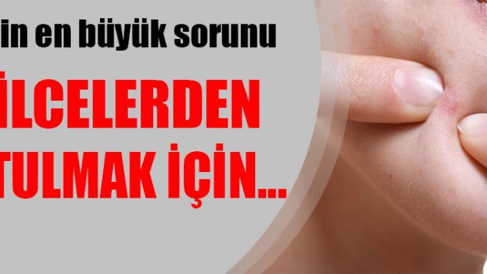 Herkesin en büyük sorunu! Sivilcelerden kurtulmak için ne yapılmalı?