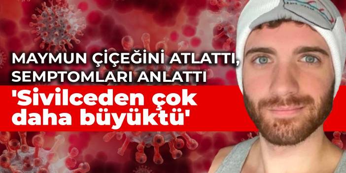 Maymun çiçeğini atlattı, semptomları anlattı