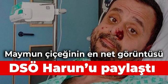 DSÖ maymun çiçeğine yakalanan Harun'un fotoğraflarını paylaştı