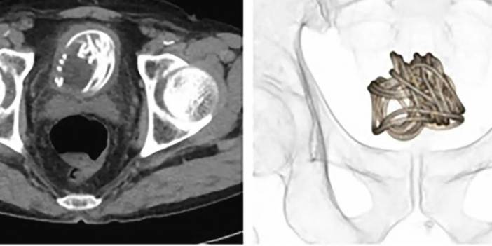 Penisinden soktuğu ip mesanesinde sıkışıp kaldı