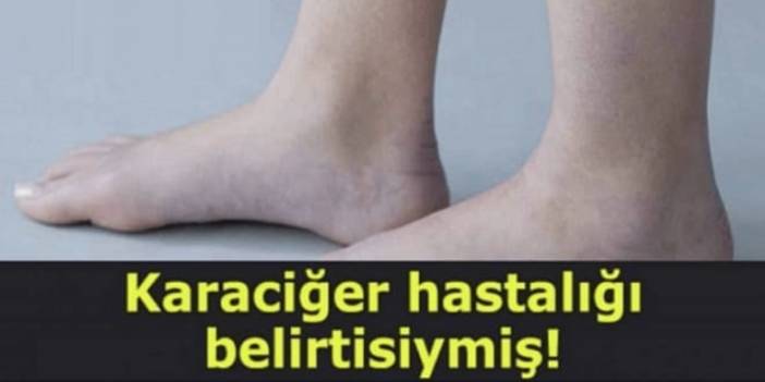 Karaciğer rahatsızlığının belirtisiymiş! Şimdiye dek kimse dikkat etmiyordu