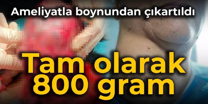 Ameliyatla boynundan çıkartıldı: Tam olarak 800 gram