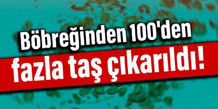 Böbreğinden 100'den fazla taş çıkarıldı!