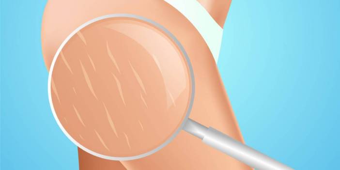 Selülit Yapan Besinler Nelerdir? Selüliti Olanlar Dikkat Bu Besinlerden Uzak Durun!